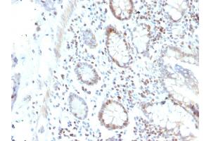 Formalin-fixed, paraffin-embedded human Colon Carcinoma stained with RAD51 Mouse Monoclonal Antibody (RAD51/2702). (RAD51 抗体  (AA 1-134))