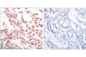 Immunohistochemistry analysis of paraffin-embedded human breast carcinoma, using NF-kappaB p100/p52 (Phospho-Ser865) Antibody. (NFKB2 抗体  (pSer866))
