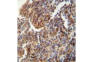 Immunohistochemistry analysis in formalin fixed and paraffin embedded human lung carcinoma reacted with HFM1 Antibody (C-term) followed which was peroxidase conjugated to the secondary antibody and followed by DAB staining. (HFM1 抗体  (C-Term))