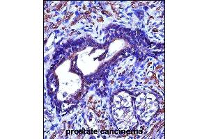 ACTG2 Antibody (C-term) (ABIN657460 and ABIN2846487) immunohistochemistry analysis in formalin fixed and paraffin embedded human prostate cancinoma followed by peroxidase conjugation of the secondary antibody and DAB staining. (ACTG2 抗体  (C-Term))