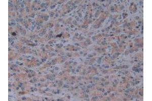 IHC-P analysis of Human Prostate Gland Cancer Tissue, with DAB staining. (Fibrillin 1 抗体  (AA 246-389))