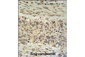DDX23 Antibody IHC analysis in formalin fixed and paraffin embedded lung carcinoma followed by peroxidase conjugation of the secondary antibody and DAB staining. (DDX23 抗体  (AA 248-277))