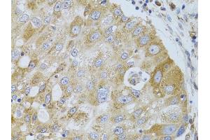 Immunohistochemistry of paraffin-embedded human breast cancer using HD antibody (ABIN6128014, ABIN6141689, ABIN6141690 and ABIN7101785) at dilution of 1:100 (40x lens). (HDAC8 抗体  (AA 1-377))