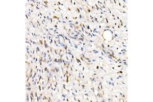 Immunohistochemistry of paraffin-embedded Human epithelioid sarcoma (ini-1 deletion) using SM/SNF5 Rabbit pAb  at dilution of 1:250 (40x lens). (SMARCB1 抗体  (AA 77-376))