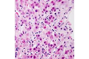 Immunohistochemical analysis of Glucagon Receptor staining in human liver cancer formalin fixed paraffin embedded tissue section. (Glucagon Receptor 抗体  (Center))