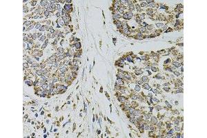 Immunohistochemistry of paraffin-embedded Human esophageal cancer using SELP Polyclonal Antibody at dilution of 1:100 (40x lens). (P-Selectin 抗体)