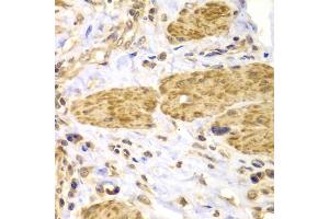 Immunohistochemistry of paraffin-embedded human gastric cancer using PTK2 antibody (ABIN5971141) at dilution of 1/100 (40x lens). (FAK 抗体)