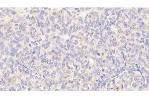 Detection of HSPA8 in Human Ovarian cancer Tissue using Polyclonal Antibody to Heat Shock 70 kDa Protein 8 (HSPA8) (Hsc70 抗体  (AA 534-615))