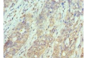 Immunohistochemistry of paraffin-embedded human endometrial cancer using ABIN7169126 at dilution of 1:100 (PAK1 抗体  (AA 1-240))