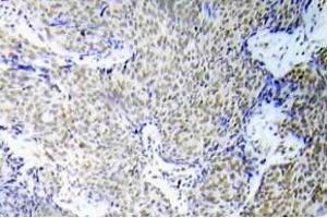 Immunohistochemistry (IHC) analyzes of p-GATA-1 antibody in paraffin-embedded human lung adenocarcinoma tissue. (GATA1 抗体  (pSer310))