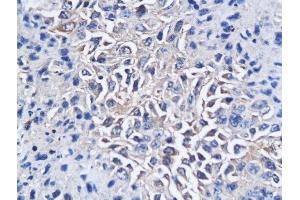 Formalin-fixed and paraffin embedded mouse hepatic tumor labeled with Anti-CD150/SLAMF1 Polyclonal Antibody, Unconjugated followed by conjugation to the secondary antibody and DAB staining (SLAMF1 抗体  (AA 231-335))