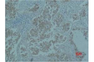 Immunohistochemistry (IHC) analysis of paraffin-embedded Human Lung Carcicnoma using Catenin-beta Monoclonal Antibody. (beta Catenin 抗体)