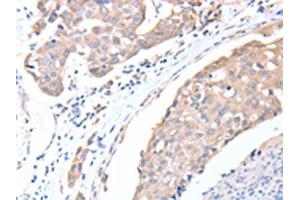 The image on the left is immunohistochemistry of paraffin-embedded Human breast cancer tissue using ABIN7128194(ACTL8 Antibody) at dilution 1/15, on the right is treated with fusion protein. (Actin-Like 8 抗体)