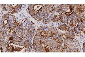 Human adenocarcinoma of endometrium: immunohistochemical staining on CA125. (MUC16 抗体)