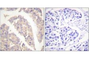 Immunohistochemistry analysis of paraffin-embedded human breast carcinoma tissue, using CBL (Ab-700) Antibody. (CBL 抗体  (AA 666-715))