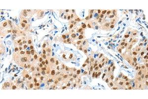 Immunohistochemistry of paraffin-embedded Human lung cancer using APPL1 Polyclonal Antibody at dilution of 1:70 (APPL1 抗体)