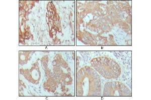 Immunohistochemical analysis of paraffin-embedded human breast carcinoma (A), hepatocarcinoma (B), stomach cancer (C) and colon cancer tissue (D), showing cytoplasmic location with DAB staining using CK18 antibody. (Cytokeratin 18 抗体  (AA 391-483))