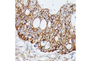 Immunohistochemistry of paraffin-embedded human colon carcinoma using MK4 antibody (ABIN7268654) at dilution of 1:100 (40x lens). (MAP3K4 抗体  (AA 1-100))