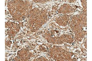 Immunohistochemistry analysis using Rabbit Anti-ROR1 Polyclonal Antibody (ABIN5667778). (ROR1 抗体  (AA 200-300) (APC))