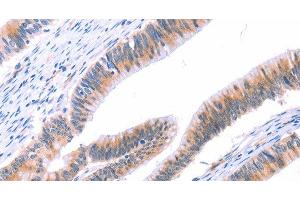 Immunohistochemistry of paraffin-embedded Human colon cancer tissue using VWF Polyclonal Antibody at dilution 1:50 (VWF 抗体)