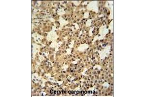 C Antibody (N-term) (ABIN650926 and ABIN2839997) immunohistochemistry analysis in formalin fixed and paraffin embedded human cervix carcinoma tissue followed by peroxidase conjugation of the secondary antibody and DAB staining. (CJ119 (AA 143-171), (N-Term) 抗体)