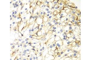 Immunohistochemistry of paraffin-embedded Human kidney cancer using VANGL2 Polyclonal Antibody at dilution of 1:100 (40x lens). (VANGL2 抗体)