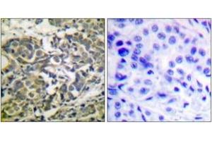 Immunohistochemistry analysis of paraffin-embedded human breast carcinoma, using AMPK alpha (Phospho-Thr172) Antibody. (AMPK alpha 抗体  (pThr183))
