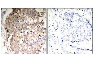 Immunohistochemical analysis of paraffin-embedded human breast carcinoma tissue, using SHP-1 (Phospho-Tyr536) Antibody (E011318). (SHP1 抗体  (pTyr536))