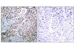 Immunohistochemical analysis of paraffin-embedded human breast carcinoma tissue using p53 (phospho- Ser315) antibody (E011100). (p53 抗体  (pSer315))