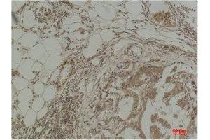 Immunohistochemical analysis of paraffin-embedded Human Breast Carcinoma using Pan Methylated Lysine Monoclonal Antibody. (Methylated Lysine 抗体)