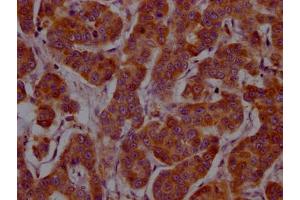 IHC image of ABIN7127570 diluted at 1:100 and staining in paraffin-embedded human breast cancer performed on a Leica BondTM system. (Recombinant IL-4 抗体)