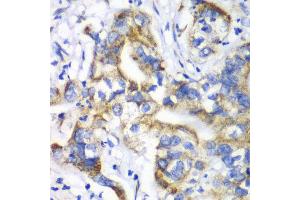Immunohistochemistry of paraffin-embedded human liver cancer using RPL9 antibody at dilution of 1:100 (x40 lens). (RPL9 抗体)