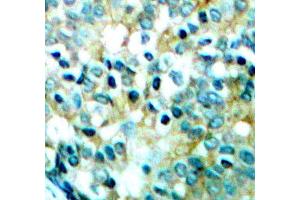 Immunohistochemistry of paraffin-embedded human breast carcinoma tissue, using Phospho-SRC-Y418 antibody (ABIN5969963). (Src 抗体  (pTyr418))