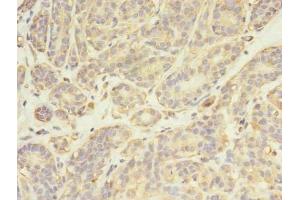 Immunohistochemistry of paraffin-embedded human breast cancer using ABIN7174025 at dilution of 1:100 (FYN 抗体  (AA 154-270))