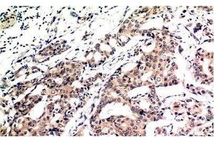 Immunohistochemistry of paraffin-embedded Human breast carcinoma tissue using Ubiquitin Monoclonal Antibody at dilution of 1:200. (Ubiquitin 抗体)
