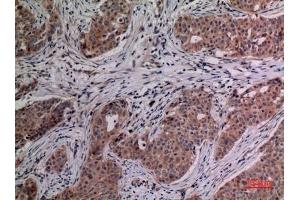 Immunohistochemical analysis of paraffin-embedded human-breast-cancer, antibody was diluted at 1:100. (IL-4 抗体  (Internal Region))