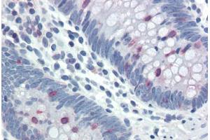 Human Colon (formalin-fixed, paraffin-embedded) stained with STAT5A/STAT5B antibody ABIN337157 at 20-40 ug/ml followed by biotinylated goat anti-rabbit IgG secondary antibody ABIN481713, alkaline phosphatase-streptavidin and chromogen. (STAT5 A/B 抗体  (pTyr694))