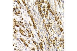 Immunohistochemistry of paraffin-embedded human stomach cancer using TACR3 antibody (ABIN5975101) at dilution of 1/100 (40x lens). (TACR3 抗体)