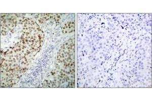 Immunohistochemistry (IHC) image for anti-Tumor Protein P53 (TP53) (AA 1-50) antibody (ABIN2889047) (p53 抗体  (AA 1-50))