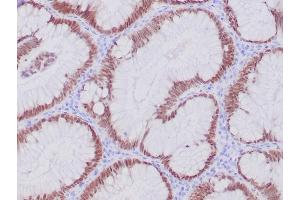 IHC analysis of formalin-fixed, paraffin-embedded human colon adenocarcinoma. (Recombinant CDX2 抗体)