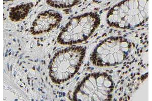 ABIN6267350 at 1/200 staining human colon carcinoma tissue sections by IHC-P. (Bcl-2 抗体  (pSer87))
