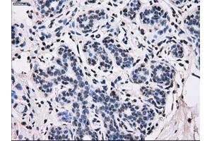 Immunohistochemical staining of paraffin-embedded breast tissue using anti-ID3 mouse monoclonal antibody. (ID3 抗体)