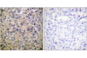 Immunohistochemistry analysis of paraffin-embedded human breast carcinoma tissue, using PP1-alpha (Ab-320) Antibody. (PPP1CA 抗体  (AA 281-330))