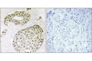 Immunohistochemistry analysis of paraffin-embedded human breast carcinoma tissue, using hnRNP M Antibody. (HNRNPM 抗体  (AA 11-60))