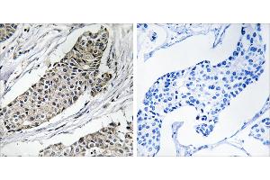 Peptide - +Immunohistochemistry analysis of paraffin-embedded human breast carcinoma tissue using KCNAB3 antibody. (KCNAB3 抗体  (C-Term))