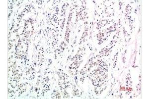 Immunohistochemical analysis of paraffin-embedded Human Stomach Carcinoma Tissue using Phospho-Smad3(S425) Mouse mAb diluted at 1:200. (Phospho-SMAD3(S425) (pSer425) 抗体)
