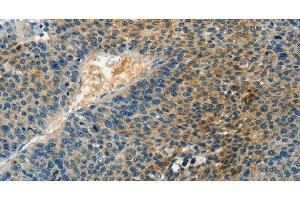 Immunohistochemistry of paraffin-embedded Human liver cancer tissue using DGK beta Polyclonal Antibody at dilution 1:60 (DGKB 抗体)