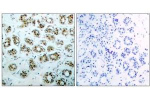 Immunohistochemical analysis of paraffin-embedded human breast carcinoma tissue, using NFκB-p65 (phospho-Ser311) antibody (E011260). (NF-kB p65 抗体  (pSer311))