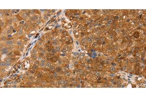 Immunohistochemistry of paraffin-embedded Human breast cancer tissue using TMSB10 Polyclonal Antibody at dilution 1:35 (Thymosin beta 10 抗体)