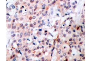 Immunohistochemistry of paraffin-embedded Human breast carcinoma tissue, using Phospho-Bcl-2(T56) Polyclonal Antibody (Bcl-2 抗体  (pThr56))